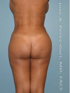 after back view vaser lipo of female patient 3177