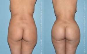Before and after brazilian butt lift female patient rear view