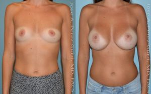 Before and after breast augmentation female patient front view Imagos Plastic Surgery