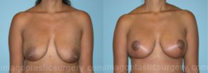 Before and after breast list front view Imagos Plastic Surgery