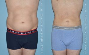 Before and after liposuction view of stomach male patient