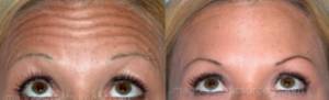 Before and after Botox female patient forehead