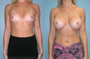 Before and after breast augmentation female patient front view Imagos Plastic Surgery