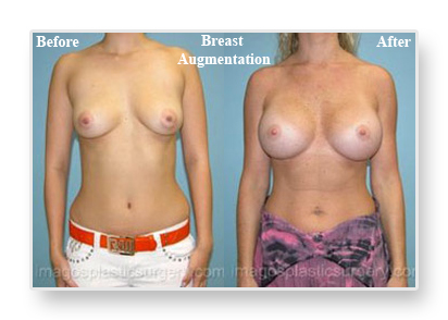 Before and after breast augmentation front view