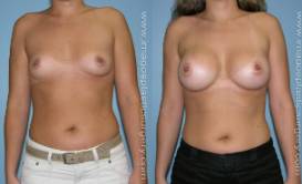 Before and after breast augmentation female patient front view Imagos Plastic Surgery