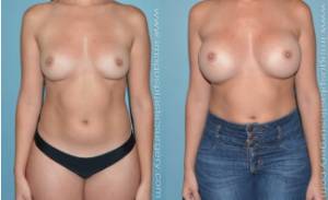 Before and after breast augmentation female patient front view Imagos Plastic Surgery