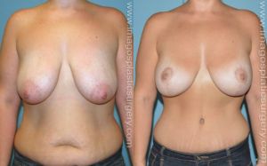 Before and after breast lift front view Imagos Plastic Surgery