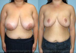 Before and after breast reduction front view Imagos Plastic Surgery