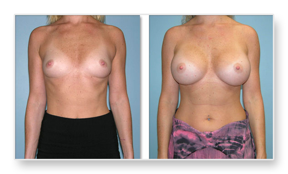 Before and after breast augmentation front view