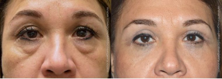 Before and after eyelid surgery Imagos Plastic Surgery