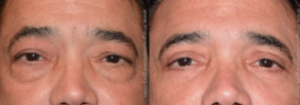 Before and after upper and lower eyelid surgery male patient Imagos Plastic Surgery