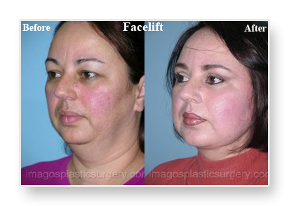 Before and after facelift left angle female patient