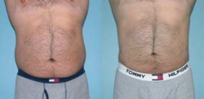 Before and after tummy tuck male patient front view Imagos Plastic Surgery