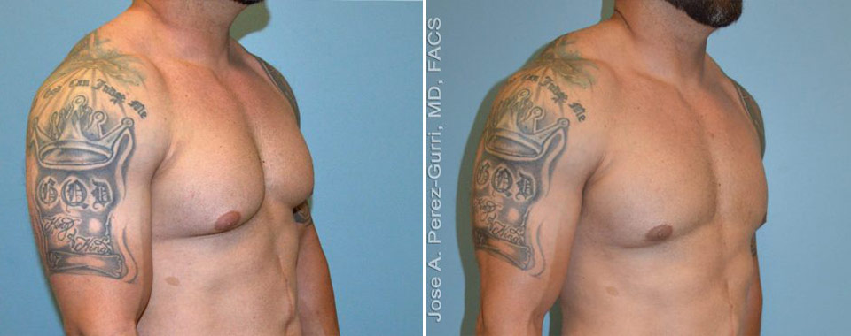 Before and after gynecomastia right angle view