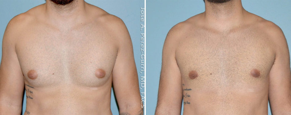 Gynecomastia before and after front view Imagos Plastic Surgery