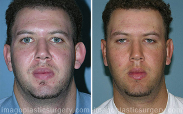 Before and after ear surgery male patient front view Imagos Plastic Surgery
