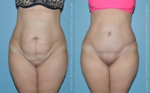 Before and after tummy tuck female patient front view