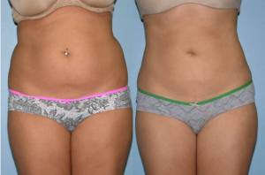 Before and after liposuction female patient front view