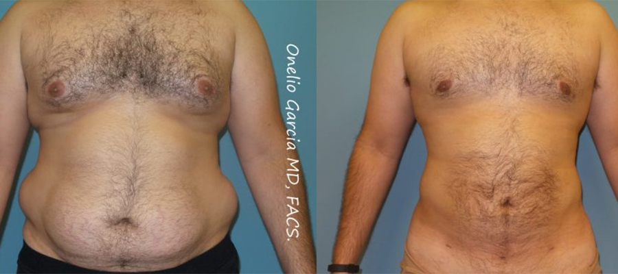 Before and after vaserlipo male patient front view