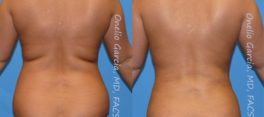 Before and after vaserlipo back view female patient