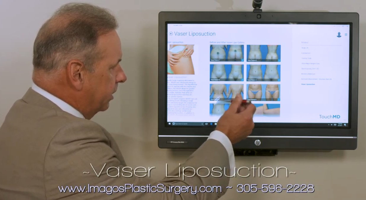 Dr talking about vaser liposuction procedure