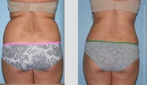 Before and after liposuction hips female patient back view
