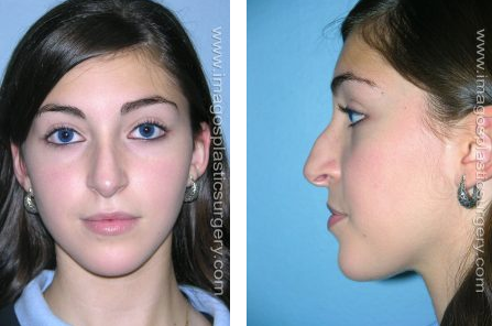 Before female rhinoplasty front and left side image