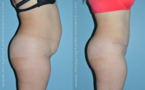 Tummy tuck before and after right side Imagos plastic surgery