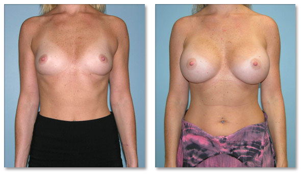 Before and after breast augmentation female patient front view Imagos Plastic Surgery