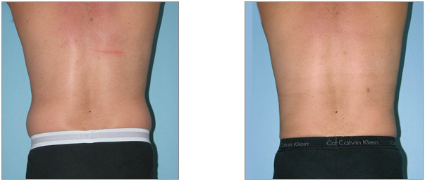 Before and after liposuction male patient back view