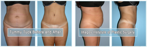 Before and after tummy tuck female patient front and side views