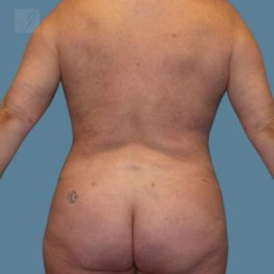 after vaser lipo back female patient case 5