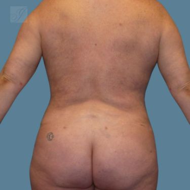 after vaser lipo back female patient case 5