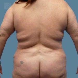 before vaser lipo back female patient case 5