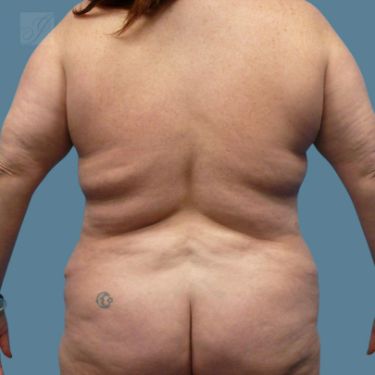 before vaser lipo back female patient case 5