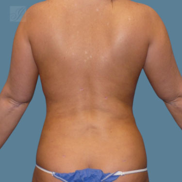 after vaser lipo back female patient case 4