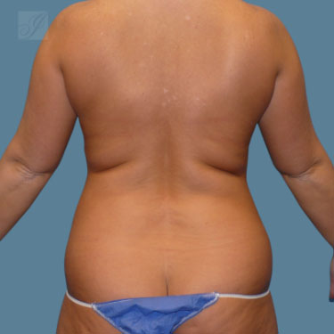 before vaser lipo back female patient case 4
