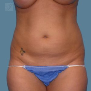 before vaser lipo stomach female patient case 4