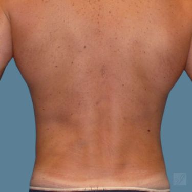 before vaser lipo stomach back view male case 3