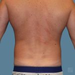 after vaser lipo stomach back view male case 3