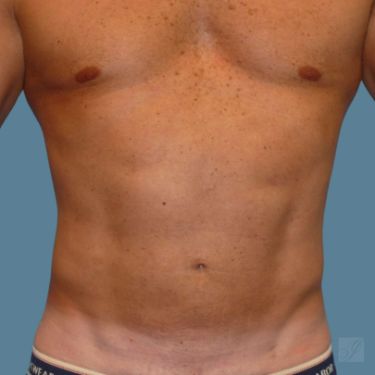 after vaser lipo stomach front view male case 3