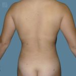 after vaser lipo stomach view back case 2