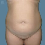 before vaser lipo stomach view front case 2