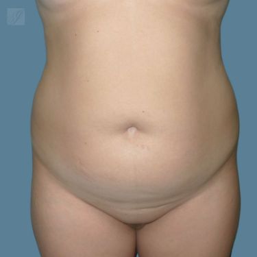 before vaser lipo stomach view front case 2