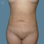 after vaser lipo stomach view front case 2