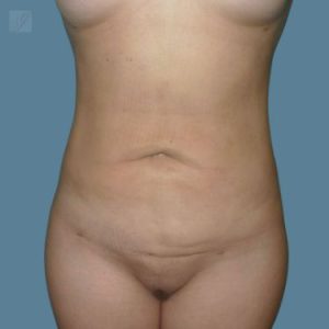 after vaser lipo stomach view front case 2