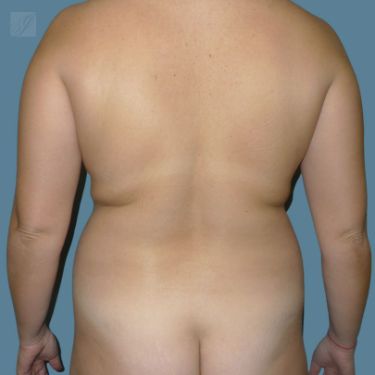 before vaser lipo stomach view back case 2