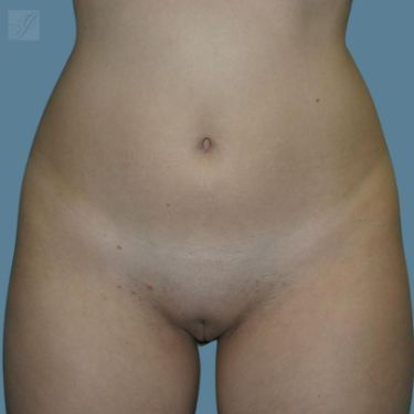 before vaser lipo front view female case 1
