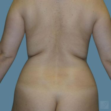 before vaser lipo back view female case 1