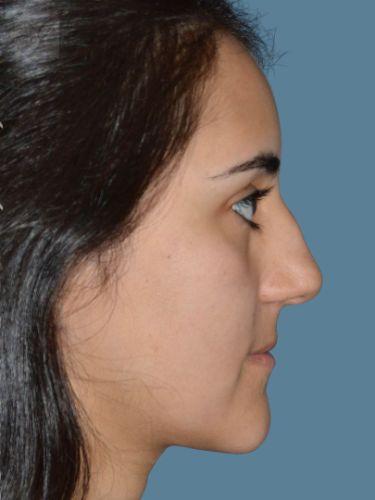 before rhinoplasty side view female patient case 2
